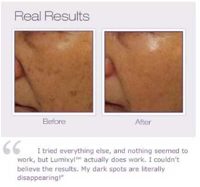 Lumixyl Topical Brightening System Before and After from Envy Medical