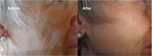 Nerium AD Before and After Results