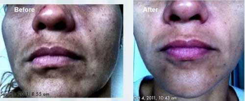 Nerium AD Before and After Results