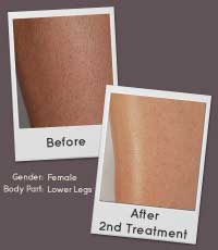 Remington i-LIGHT Pro Intense Pulsed Light Hair Removal Treatment