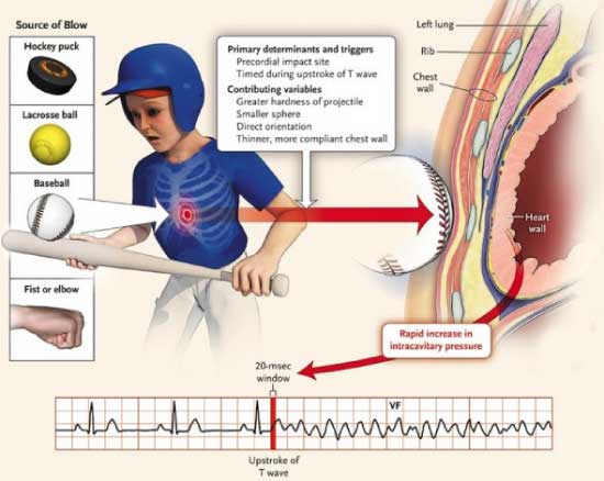 Evoshield Commotio Cordis Protection