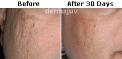 Dermagist Acne Scars Fading Results