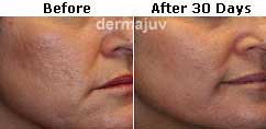 Dermagist Acne Scars Fading Results
