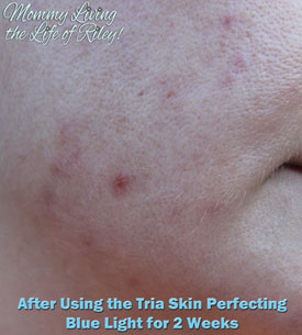 Acne After Using the Tria Skin Perfecting Blue Light for 2 Weeks