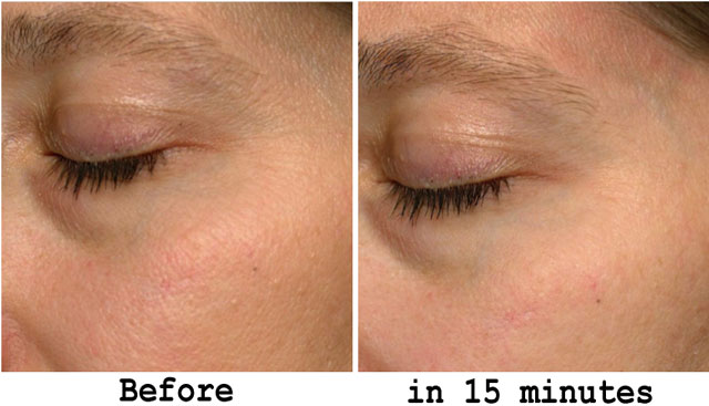 Phenomenon Topical Dermal Filler Results